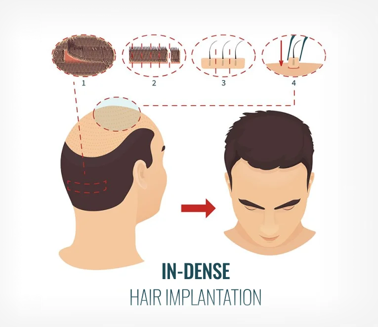 FUE Hair Transplant