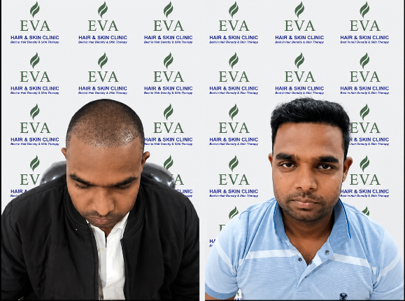 Hair transplant result