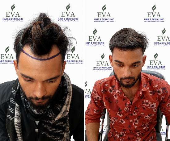 Hair transplant result