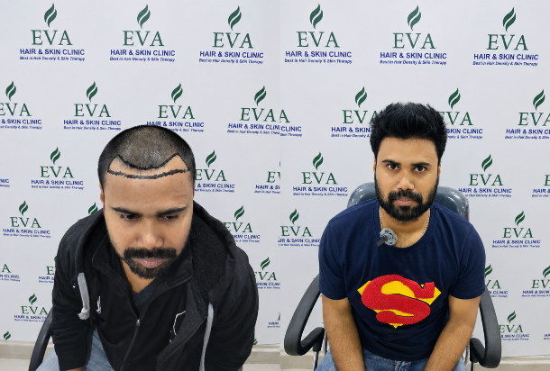 Hair transplant before and after result