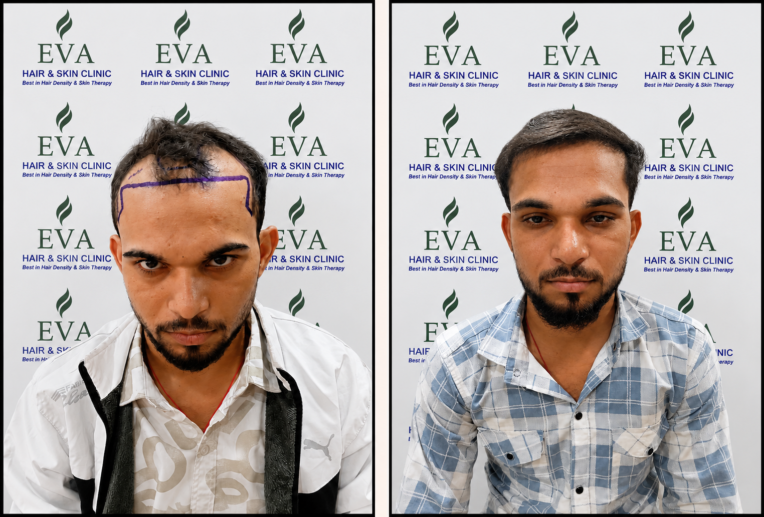 Hair Transplant at EVA CLINIC, Lucknow