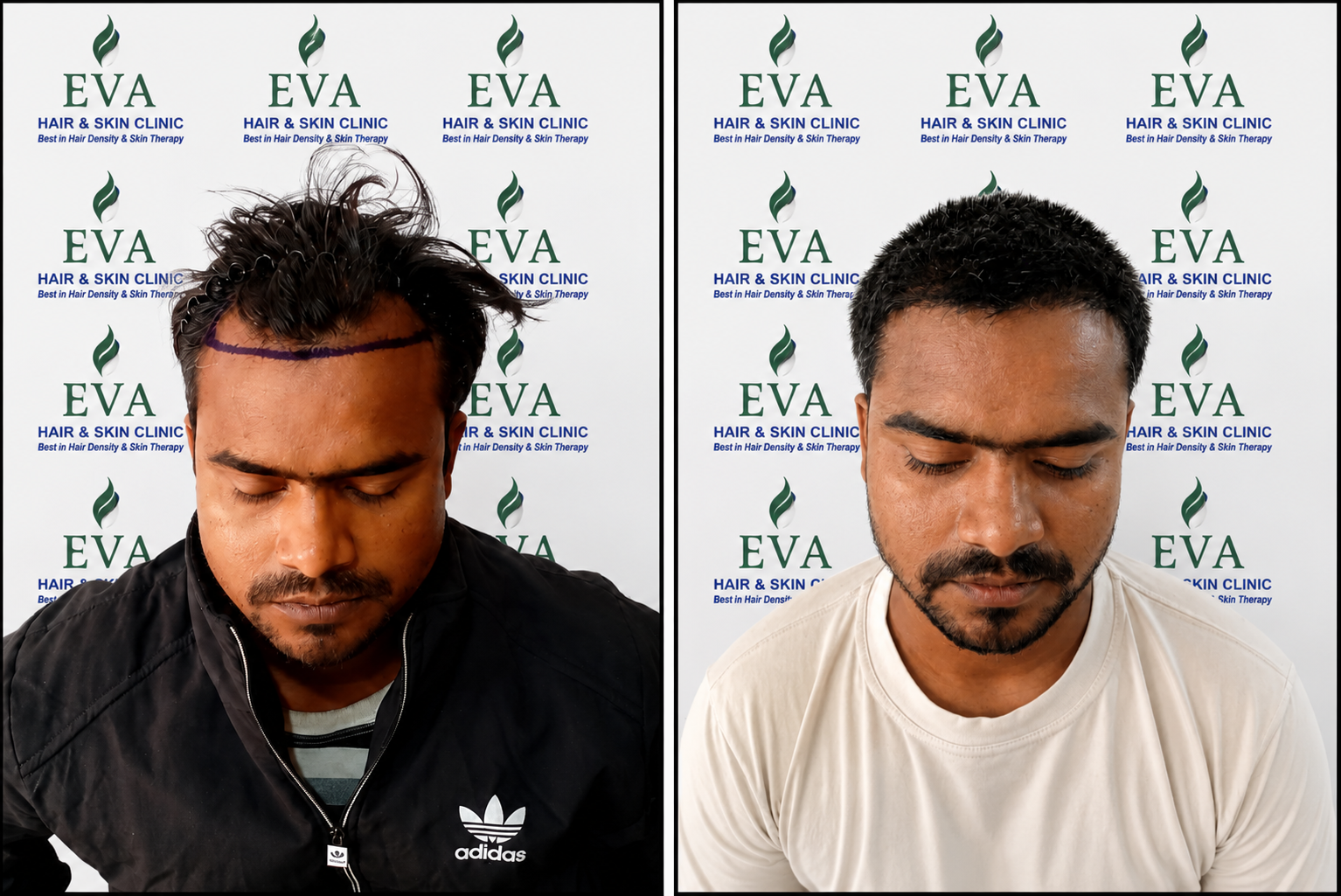 Hair Transplant Result — EVA CLINIC